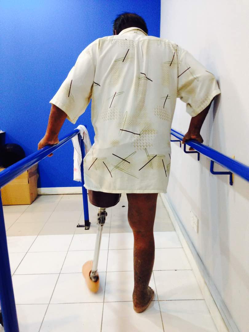 Person using an above-knee prosthetic leg between parallel bars