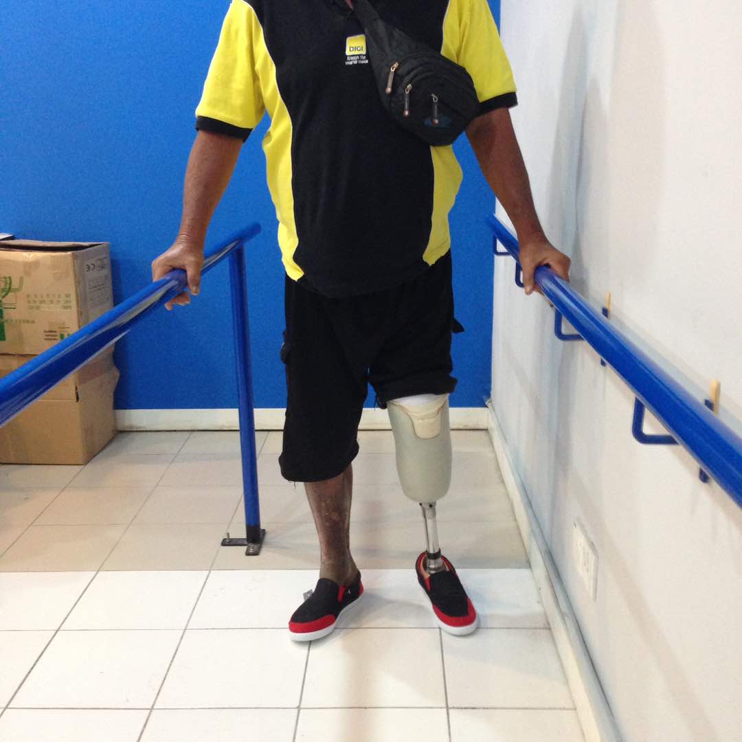 Person using a below-knee prosthetic leg between parallel bars